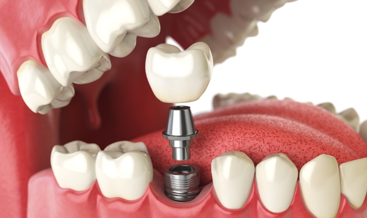 why would you get dental implants after a tooth extraction