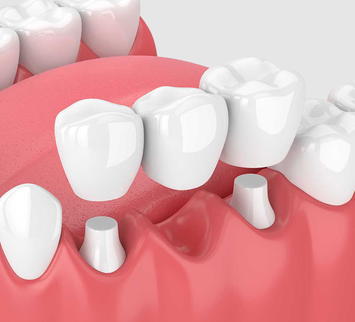 3D illustration of dental bridge placement procedure in alexandria