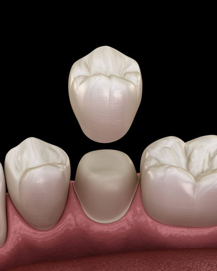3D illustration of a dental crown being placed over a prepared tooth structure