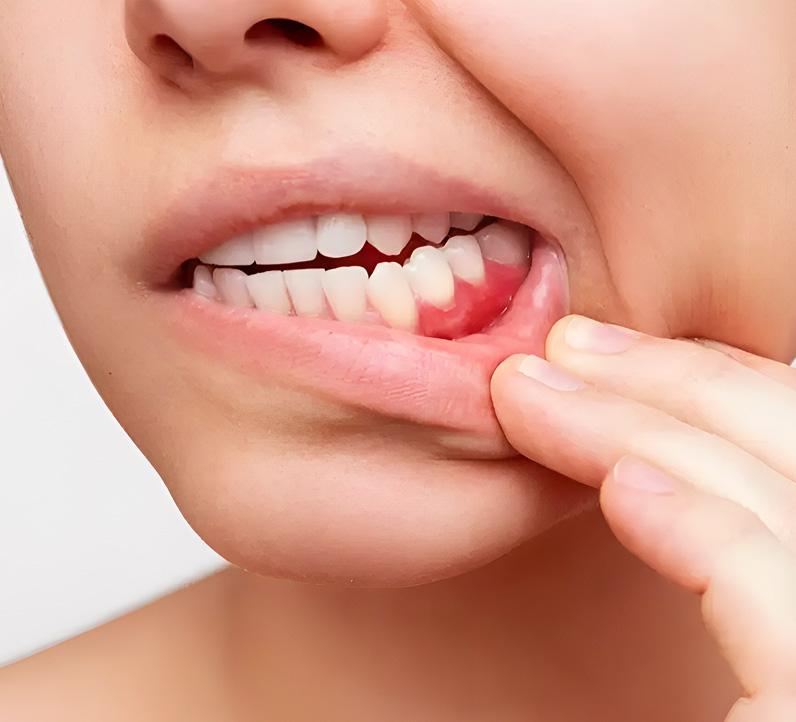 close-up of inflamed gums needing periodontal treatment in alexandria