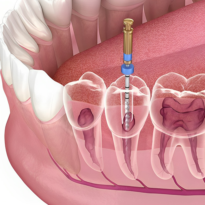 Illustration of root canal therapy procedure on a lower molar tooth in alexandria