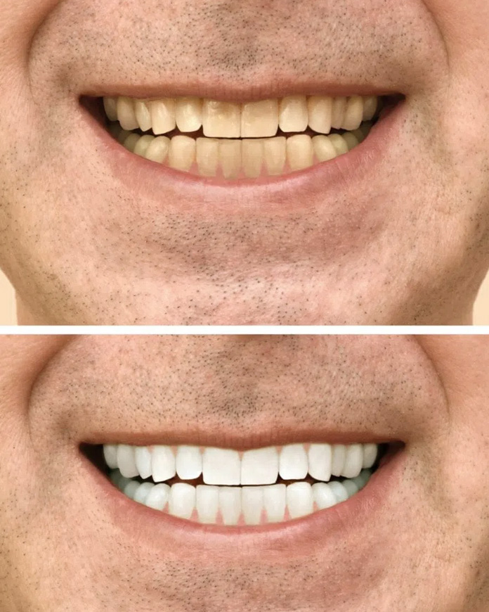comparison of a man's teeth before and after kor teeth whitening treatment in alexandria