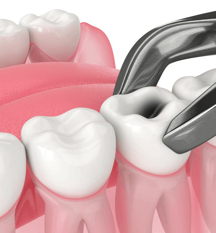 tooth extraction procedure in alexandria with dental forceps shown