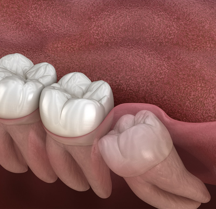 impacted wisdom tooth illustration for extractions in alexandria